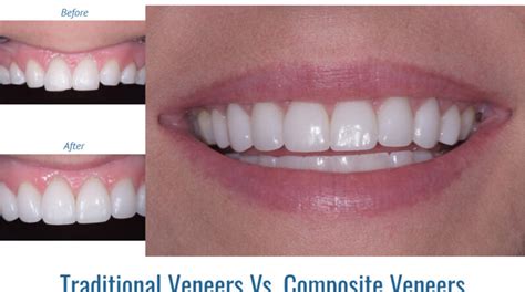 composite veneers near me|siding supply near me.